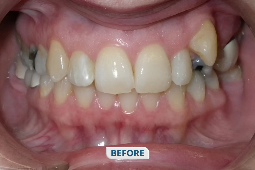 Before treatment at Namira Oro Dental Care